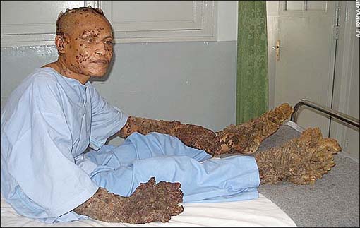 dede koswara after treatment